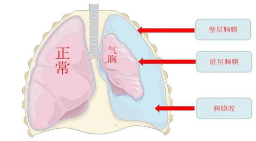 爆肺是什么？